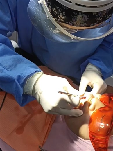 Gingivectomy ialah rawatan untuk membentuk dan membuang lebihan gusi yang menutupi gigi. Ia dilakukan bagi membantu senyuman nampak lebih seimbang serta memudahkan penjagaan kebersihan mulut. Rawatan ini biasanya dicadangkan apabila gusi terlalu tebal, tidak sekata atau menjejaskan penampilan senyuman. Tak pasti sama ada rawatan ini sesuai untuk anda atau tidak? 📲 Datang pemeriksaan dulu. Link booking ada di bio. Kami sedia membantu. #klinikpergigiansharlindah #menciptasenyumanberkualiti #denta