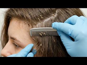 How to Remove Head Lice Safely and Effectively (Part 2)