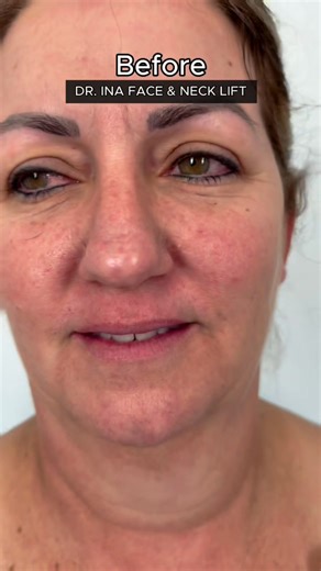 ✨ Face & Neck Lift by Dr. Ina – An incredible transformation by a true facial specialist. Trust your face to the hands of an expert in cosmetic surgery. Natural, elegant results at EvolutionMD. 📍12781 Miramar Pkwy Unit 304, FL 33027 📞 954-367-7984 | 🌐 http://www.evolutionmd.com?utm_campaign=meetedgar&utm_medium=social&utm_source=meetedgar.com #FaceLift #NeckLift #DrIna #FacialSurgery #EvolutionMD #PlasticSurgeryMiami #NaturalResults #BeautyByDesi | Evolution MD