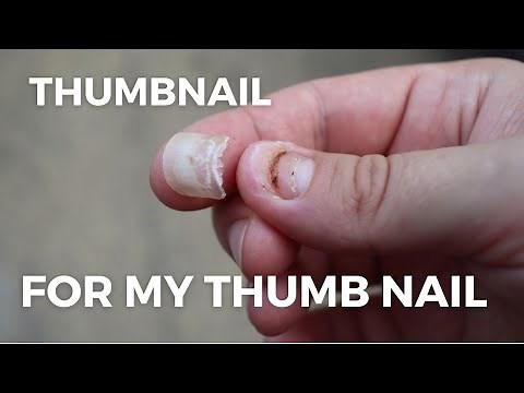 Smashed Nail Falling Off - Subungual Hematoma Time Lapse