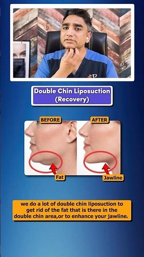 Double Chin Liposuction Recovery - How is the Recovery of Chin Lipo?
