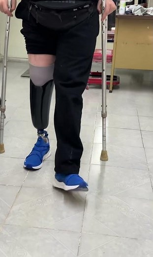 Prótesis Transtibial (socket contacto total en muñón largo)
