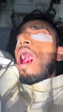 Peritonsillar abscess operation