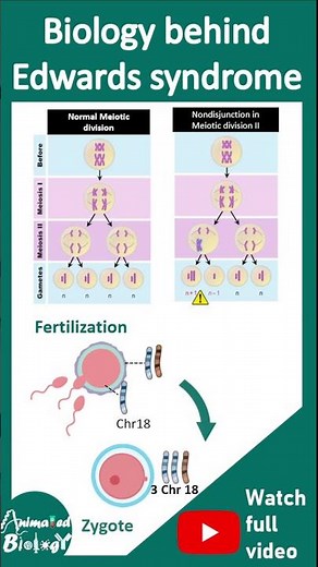 Edward syndrome | pathology in 1 minute | usmle