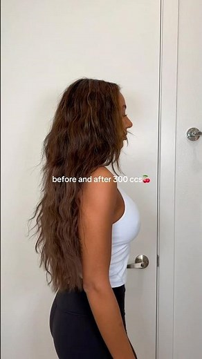 BEFORE AND AFTER 300 CC BREAST IMPLANTS🍒