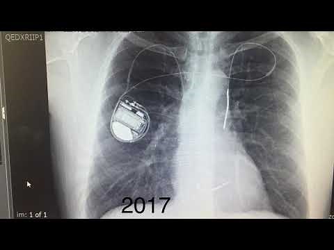 Medtronic Patient Services recording regarding Airport Security