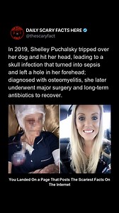 In 2019, Shelley Puchalsky tripped over her dog and struck her head, initially believing the injury was minor. Although she received stitches, the wound became infected, spreading to her skull and triggering sepsis. Diagnosed with osteomyelitis, Shelley was left with a hole in her forehead and required major surgery followed by long-term antibiotic treatment. Her case highlights how seemingly small accidents can spiral into life-threatening conditions. ➡️ Follow @thescaryfact for everyday accide
