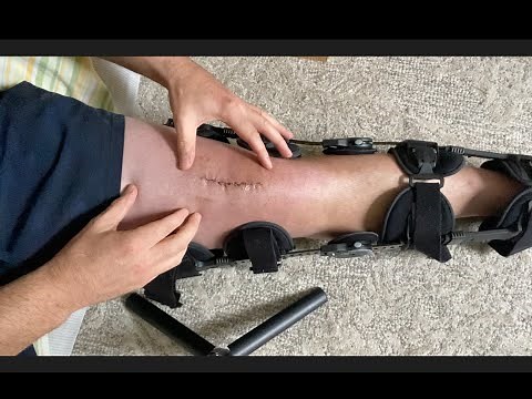 Quadriceps Tendon Repair - Week 2 Post Op