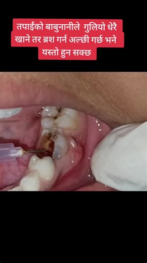 Understanding Gingival Abscess with Dr. Devraj Shrestha