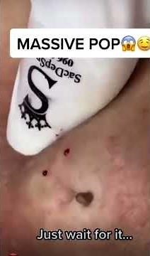 Abscess pimple cyst pop