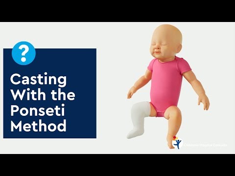 Casting With the Ponseti Method