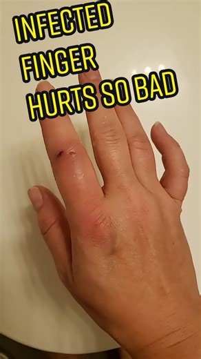 Dealing with an Infected Finger: What You Need to Know