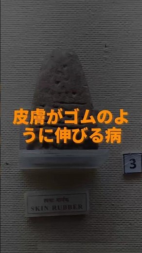 エーラス・ダンロス症候群