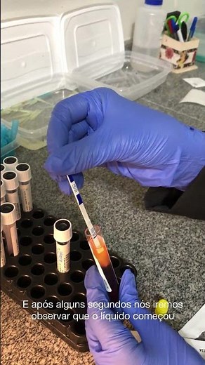 Beta-HCG Qualitativo (Exame de Gravidez) - Como é Realizado? (Análises Clínicas)