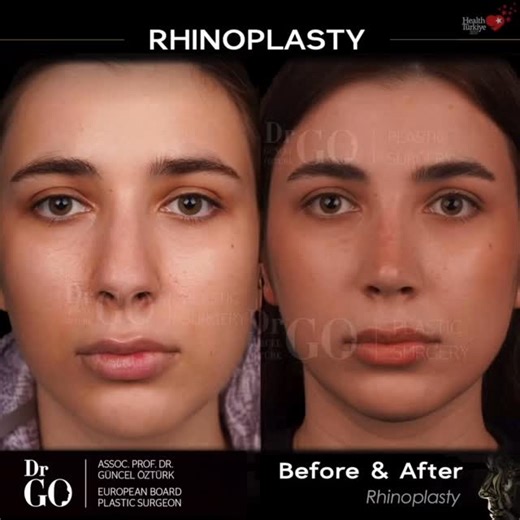 Assoc. Prof. Dr. Guncel Ozturk,MD. FEBOPRAS on Instagram: "Two years after her rhinoplasty, we’re delighted to see these lasting, beautifully natural results — a perfect harmony that stands the test of time. ✨@drgo.nose⁠ ⁠ Each facial structure requires unique methods to achieve a natural look that blends seamlessly with the rest of the face. In this procedure I used my own techniques;⁠ ⁠ New Approaches for the Let-Down Technique⁠ ⁠ ��Scroll Ligament Preservation��⁠ ⁠ Septocolumellar Flap Approa