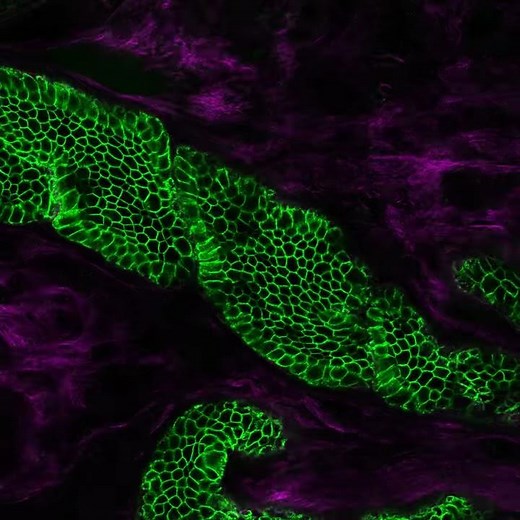 Two-photon microscopy on a biosensor shows a tumour inside living tissue