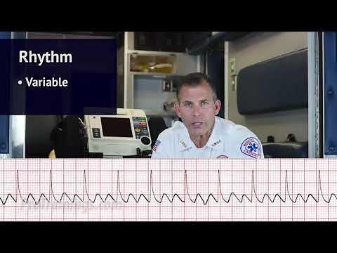 Atrial Flutter (ECG Rhythm Interpretation)