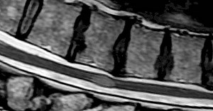Transverse myelitis: what it is, symptoms, causes and treatment