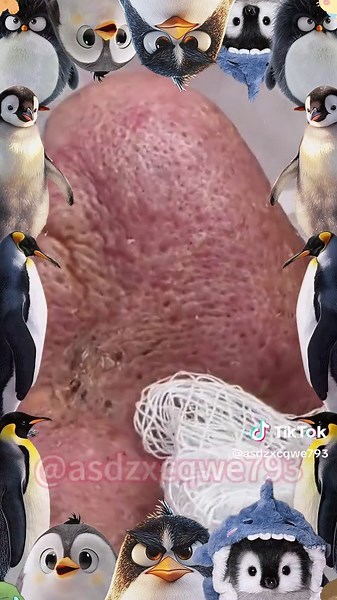 Effective Treatments for Cysts and Pimples