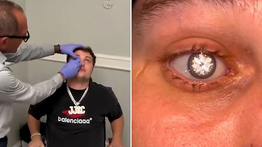 Man flaunts 2-carat diamond embedded into his artificial eye