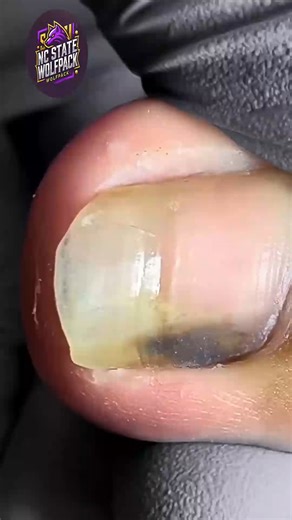 6K views · 36 reactions | Gentle Nail Tips for Overgrown Toenails That Prevent Future Issues 殺 #dailywellness #feetfirst #seniorhealth | NC State Wolfpack on TheWolfpacker.com | Facebook