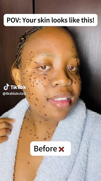 Effective Skin Tag Removal for Radiant Skin