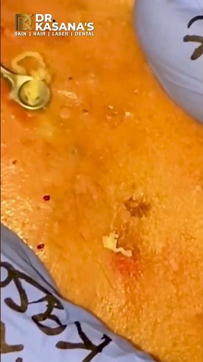 GOLDMINE OF BLACKHEADS II SUPER SATISFYING BLACKHEAD REMOVAL BY DR.LALIT KASANA