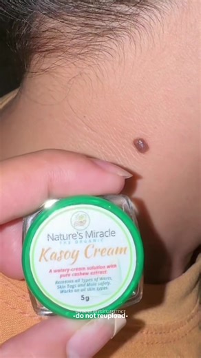 Kasoy Cream: An Effective Solution for Mole, Warts, and Skin Tag Removal