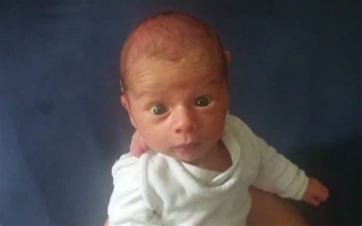 摩罗反射Moro reflex