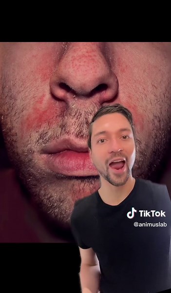 Tips para la dermatitis seborréica #caspaenlaacejas #caspaenlabarba #caspa #malassezia #dermatitisseborreica #pielgrasa #ketoconazol #azelaico #oxidodezinc #niacinamida #skincare #skincaretips #greenscreen #skincare #skincaretips