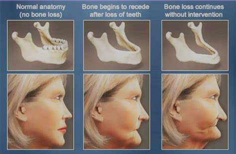 Deterioration of the Jawbone