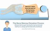 How Do You Donate Blood Marrow