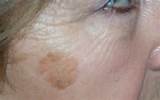 Pictures of Old Age Spot Removal