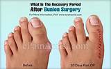 Recovery Time For Bunion Removal Photos