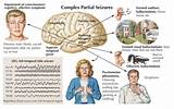 Images of Clinical Seizures Symptoms