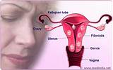 Can Fibroids Cause Pain In Your Side