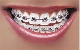 Pictures of Braces Colors Silver