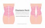 Core Strengthening Diastasis Recti Photos