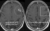 Side Effects From Gamma Knife Photos