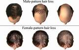 Pictures of Does Medication Cause Hair Loss
