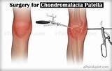 Images of Home Remedies For Chondromalacia Patella
