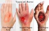 Hogweed Burn Treatment Images