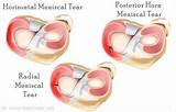 Home Remedies For Knee Ligament Tears