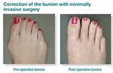 Pictures of Bunion Scar Treatment