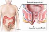 Images of Hemorrhoid Removal Doctor