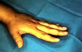 Index Finger Amputation Recovery Images
