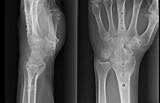 Images of Total Wrist Fusion Recovery Time