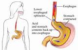 Images of Does Acid Reflux Cause Gas