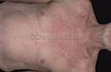 Eczema Skin Disease Treatment Images