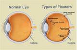 Parasite In Eye Treatment Photos